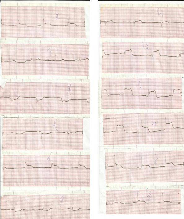 Экг при инфаркте миокарда — как выглядит на кардиограмме и какие симптомы инфаркта у мужчин и женщин