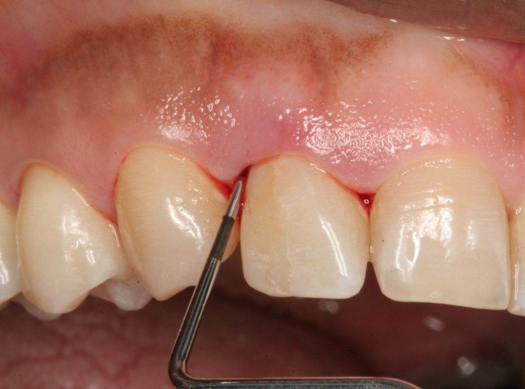Кровоточат десны при чистке зубов: лечение, причины