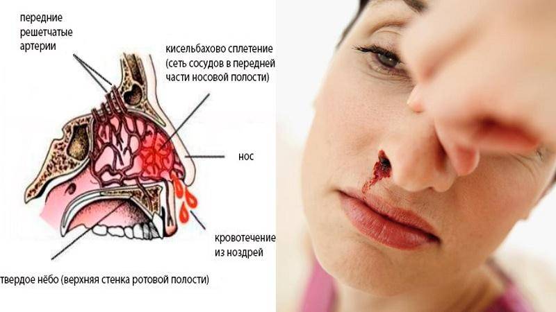 Кровь из носа у детей: причины кровотечений
