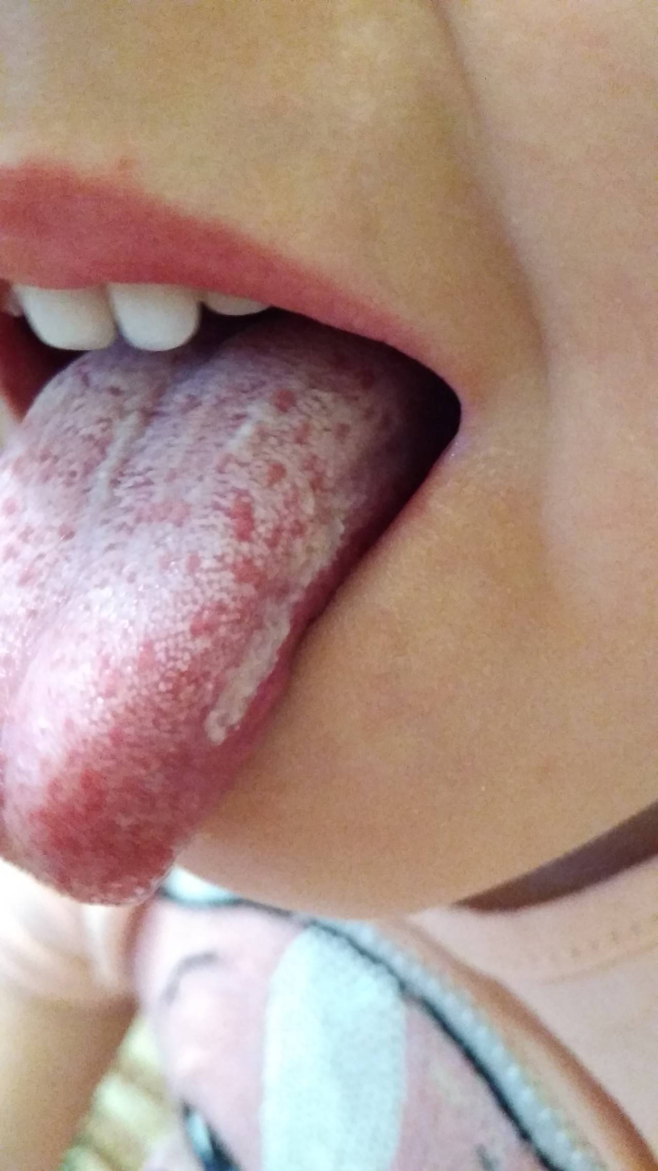 Симптомы коронавируса белый налет на языке