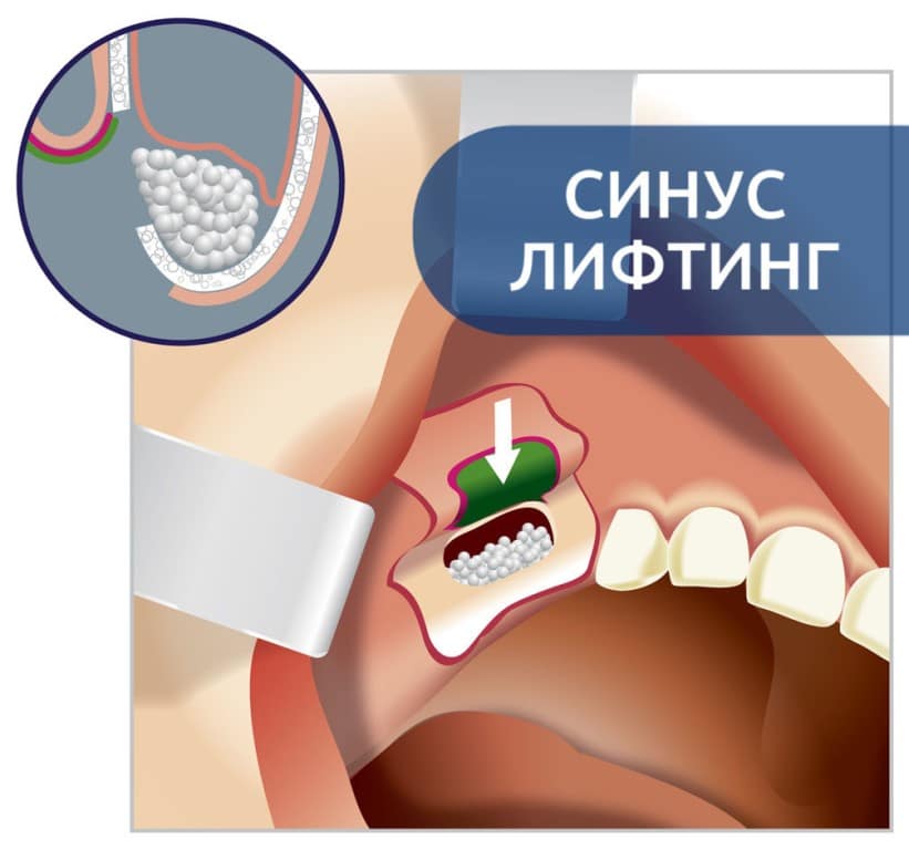 Базальная имплантация – скажи «нет» синус-лифтингу! - популярные статьи - стоматология