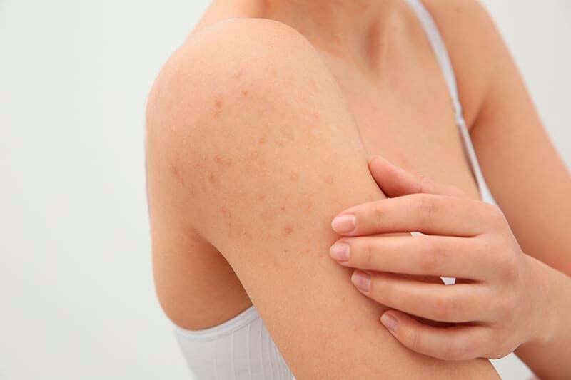 Сыпь под грудью - причины возникновения и способы лечения