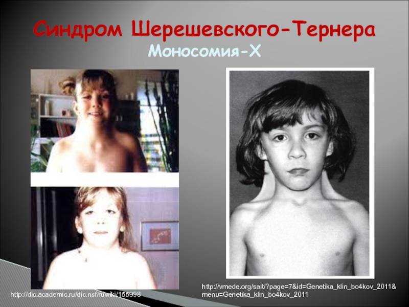 Синдром шерешевского — тёрнера: особенности течения и лечения патологии