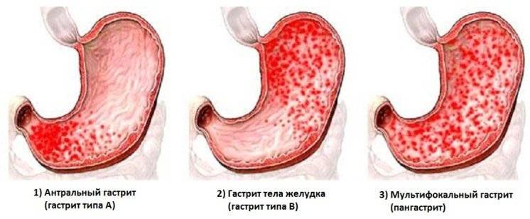 Вид слизистой желудка при хроническом гастрите