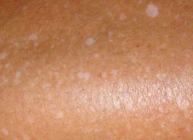 Белые пятна на коже после загара: причины, лечение, профилактика