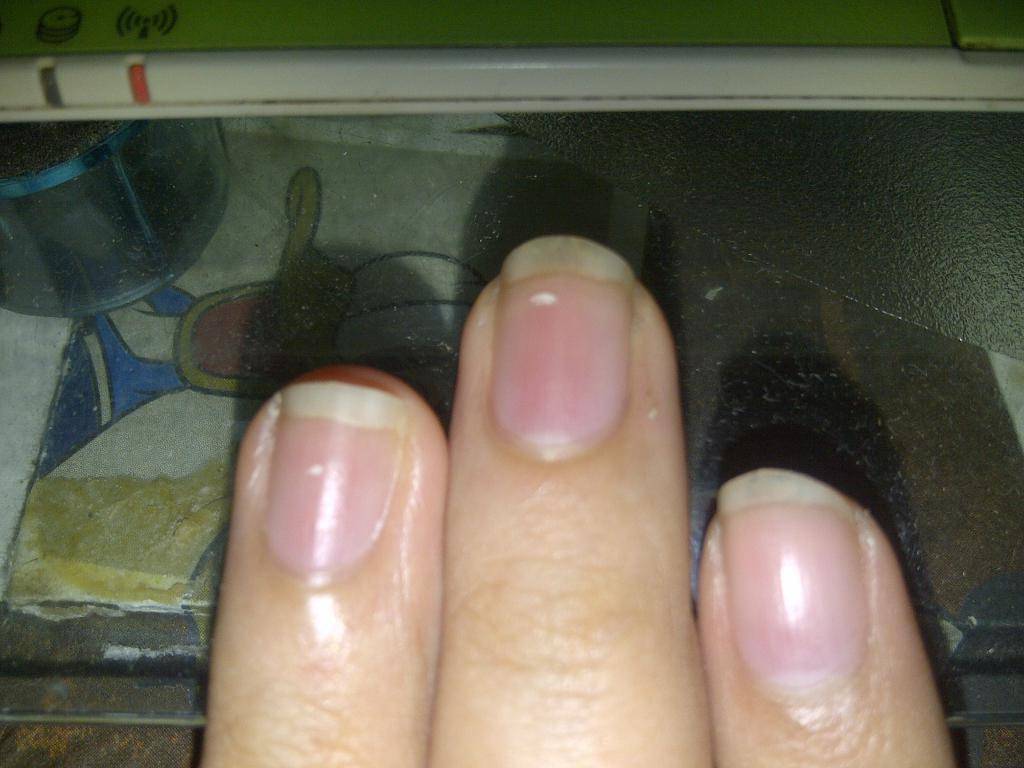 Как лечить белые пятна на ногтях пальцев рук: причины появления, способы лечения и простые профилактические меры