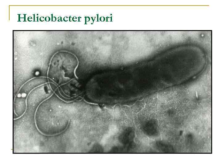 Бактерия хеликобактер пилори в желудке: причины появления
