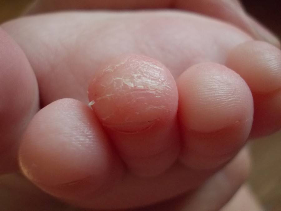 У ребенка трескается кожа на пальцах рук: причины и лечение | справочник ла-кри