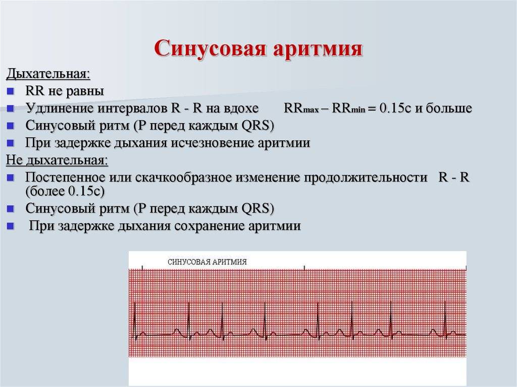 Как измерить частоту сердечных. ЭКГ критерии синусовой аритмии. 80-100 ЧСС синусовая аритмия. Синусовая тахикардия ЧСС 100 ЭКГ. Синусовая аритмия на ЭКГ У ребенка 11 лет.