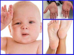 Сильная потливость ног у детей: причины и лечение