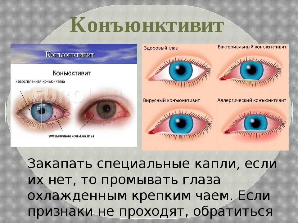 Орви и глаза. Бактериальный конъюнктивит. Симптомы конъюнктивита глаз. Бактериальныйконьюктевит.
