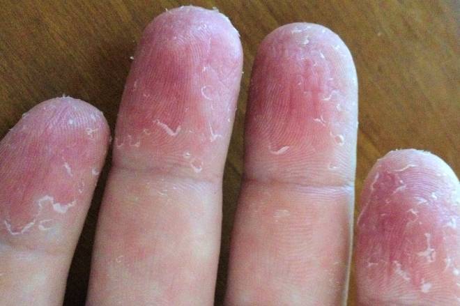 Шелушится кожа между пальцами рук: фото, возможные болезни, лечение