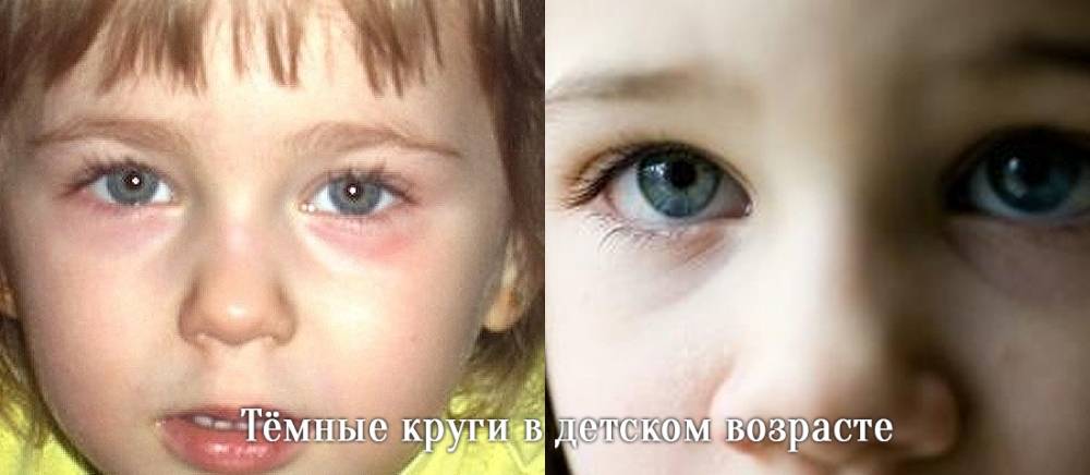 Синяки под глазами у ребенка - на коже