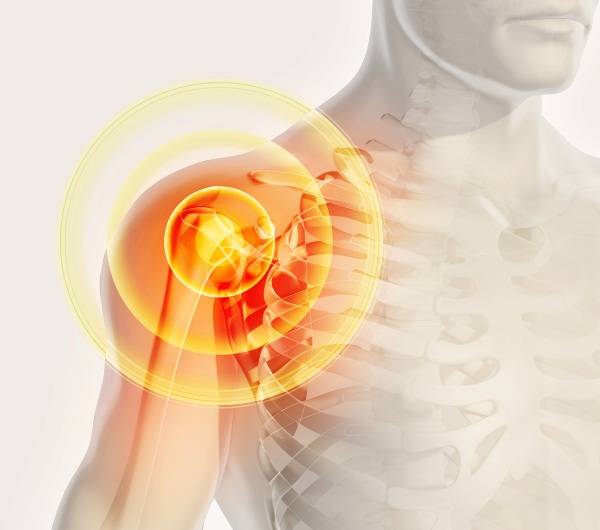 Тендинит плечевого сустава: причины, симптомы, три стадии, как лечить