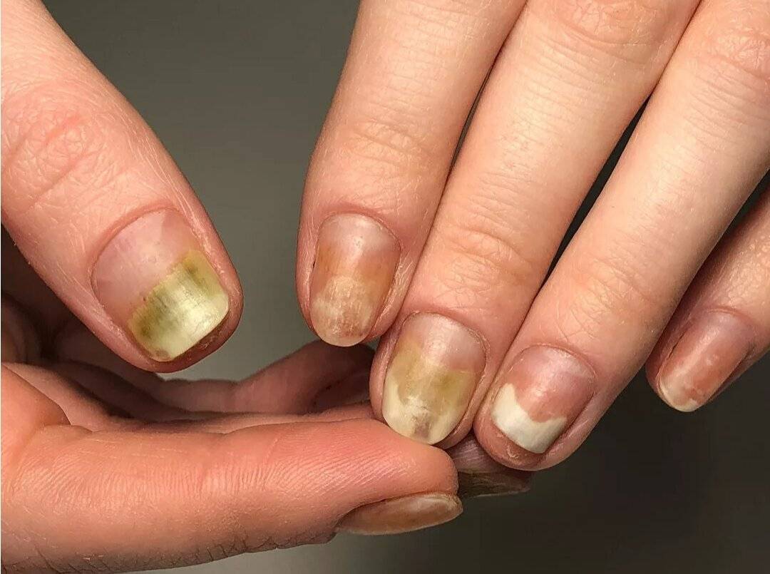 Лечение слоящихся ногтей на руках