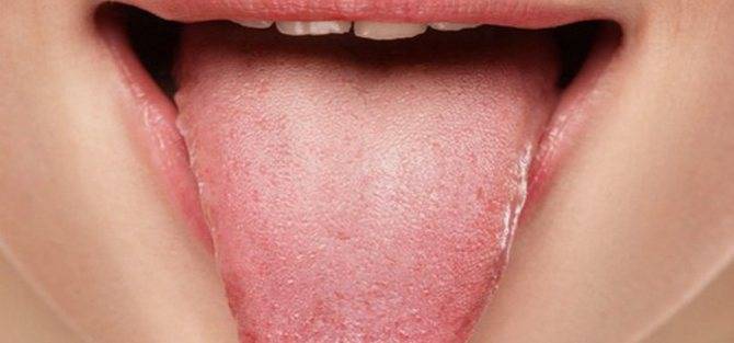 Сухость во рту при гастрите - причины данного симптомы