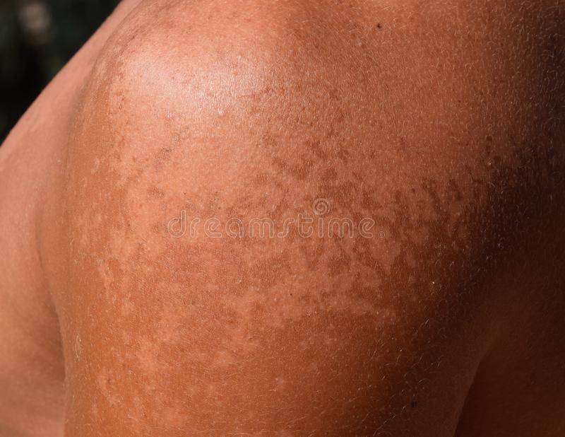 Нарушение пигментации кожи: какие причины появления белых пятен на коже?