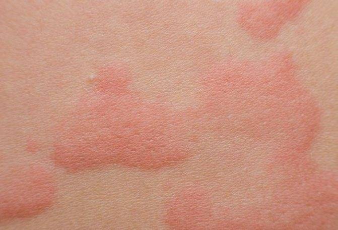Лечение аллергического дерматита у взрослых: фото, мази, народные средства