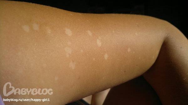 Самые популярные способы избавления от пигментации кожи после загара на солнце