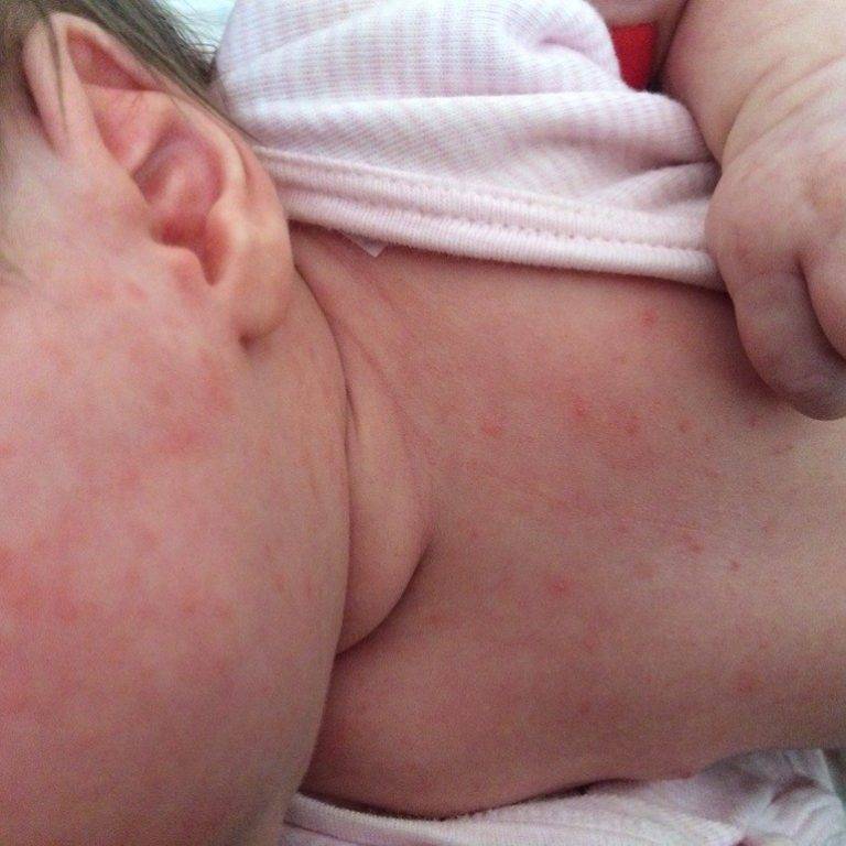 Потница на шее у грудничка: лечение и причины у новорожденных