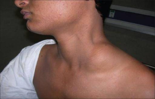 Воспаление лимфоузлов в горле: чем полоскать и как лечить