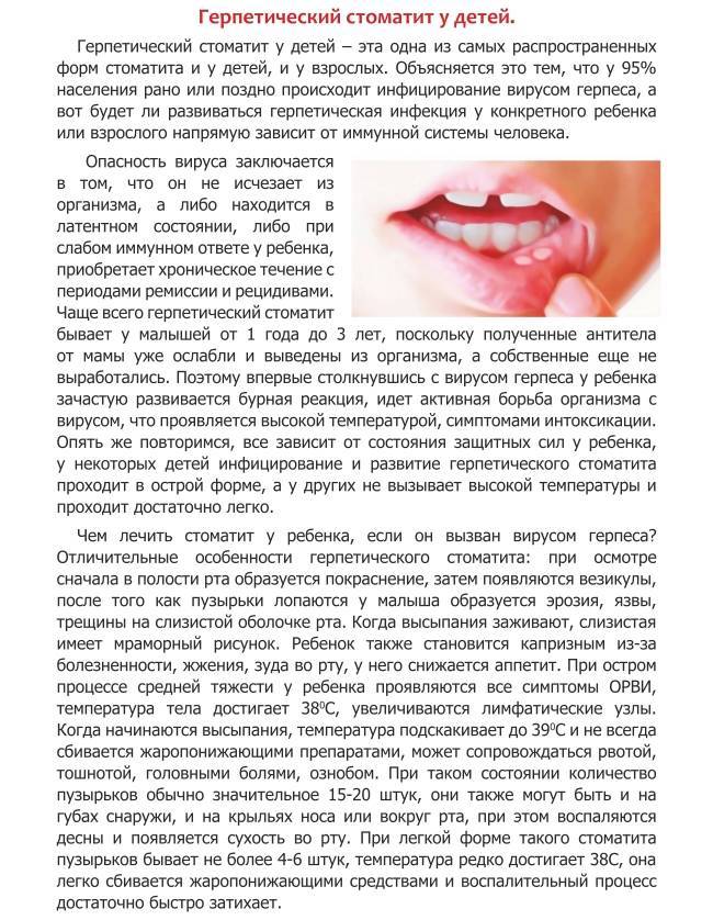 Герпетический стоматит: симптомы и лечение у детей и взрослых | pro-herpes.ru