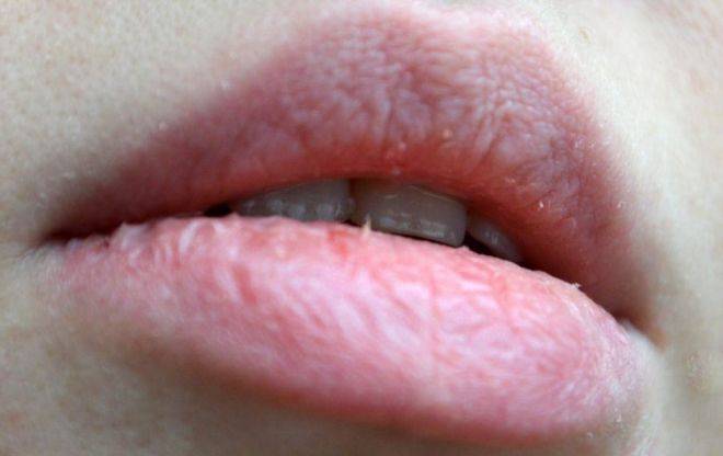 Почему трескаются губы? что делать, если сохнут уголки рта?
