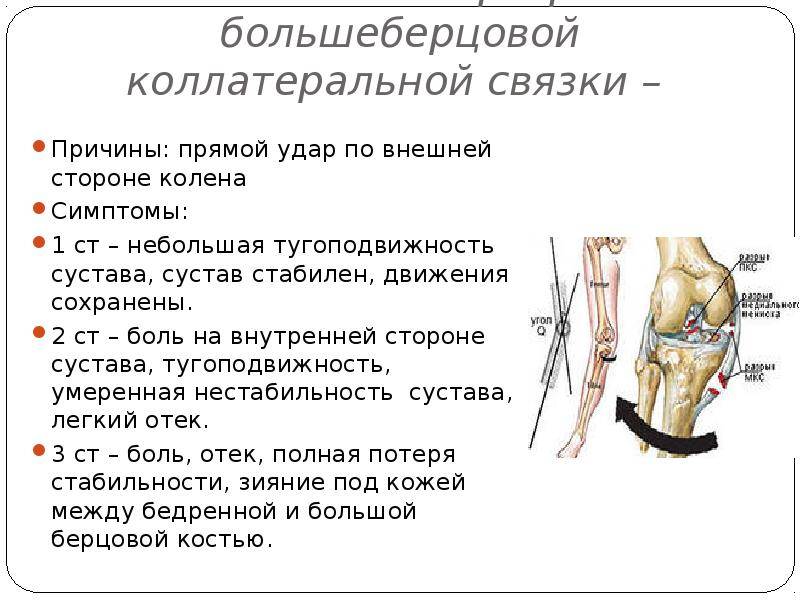 Латеральная коллатеральная связка коленного. Коллатеральная связка коленного сустава. Симптомы повреждения коллатеральной связки коленного сустава. Повреждения латеральной боковой связки колена. Травмы боковых связок коленного сустава.