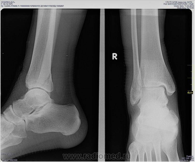 Рентген коленного сустава: что показывает снимок в двух проекциях, как делают