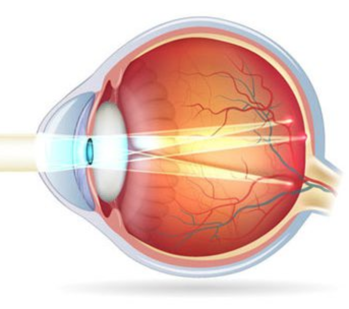 Сложный астигматизм глаз, обоих глаз – риск потерять зрение