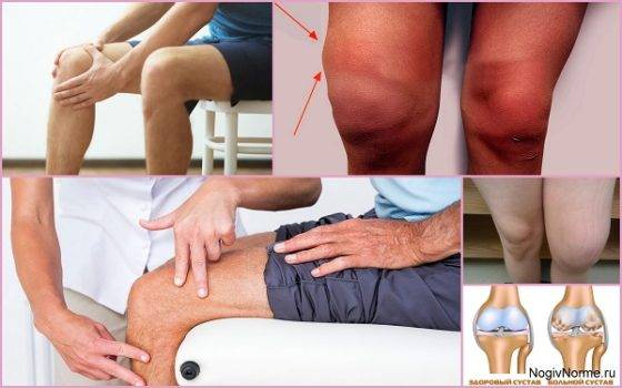 Лечение гонартроза коленных суставов 3 степени народными средствами