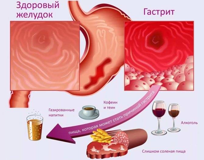 Эрозивный гастрит: симптомы, лечение, правильное питание | wmj.ru