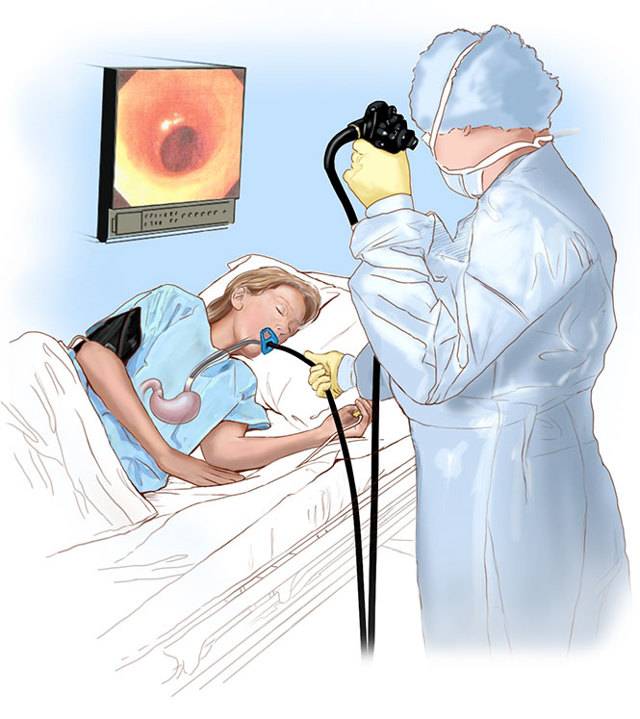 Гастроскопия желудка. как подготовиться к гастроскопии желудка?