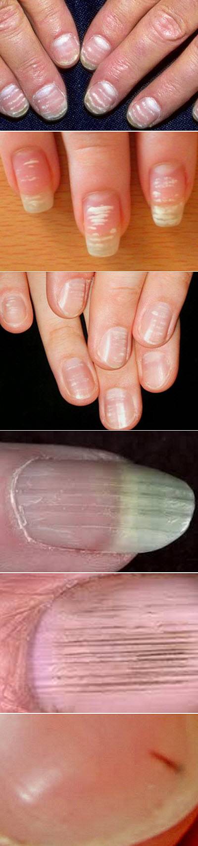 Полоски на ногтях причины вертикальные у женщин. Ониходистрофия, лейконихия. Вертикальные полосы на ногтях. Поперечные полосы на ногтях. Поперечные белые полоски на ногтях.
