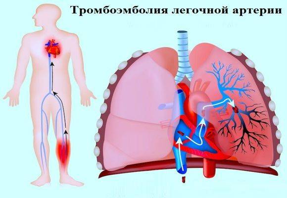 Симптомы, лечение и последствия тромбоэмболии артерии лёгких