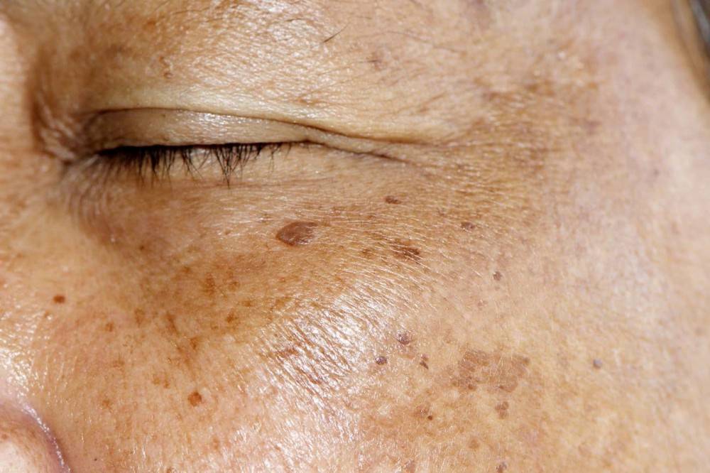 Как избавиться от пигментации на лице: убрать пигментные пятна на руках и теле, причины старческих, возрастных, удаление коричневых