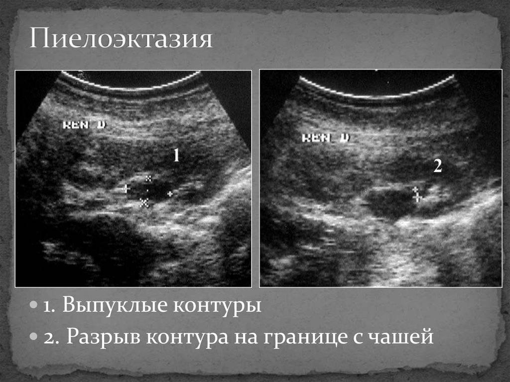 Пиелоэктазия почек у ребенка (левой, правой, обоих): что это такое, чем грозит и как лечить