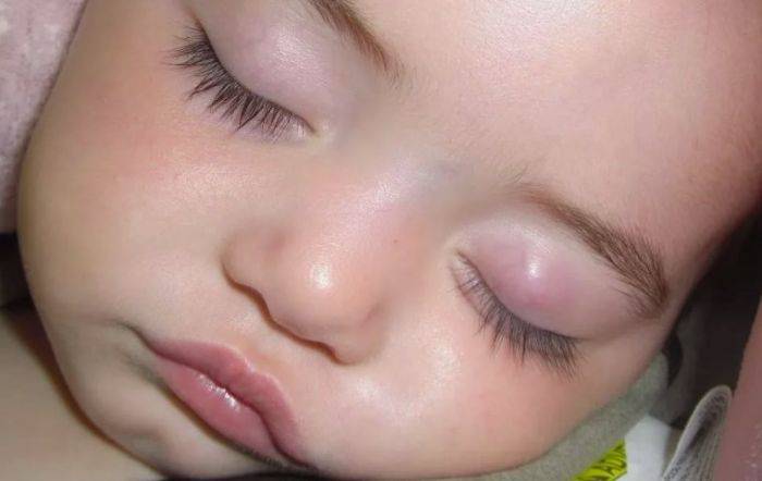 Как лечить ячмень на верхнем веке глаза у ребенка