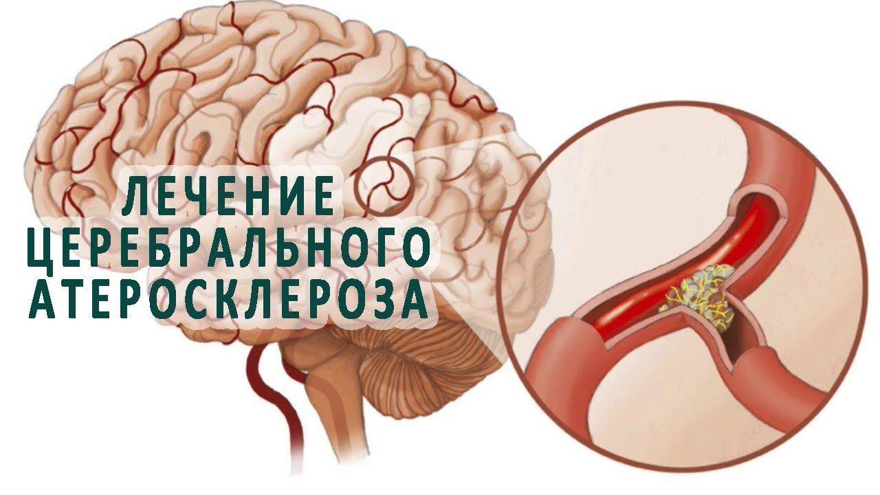 Особенности атеросклероза у пожилых людей: симптомы и лечение сосудов головного мозга и внутренних органов