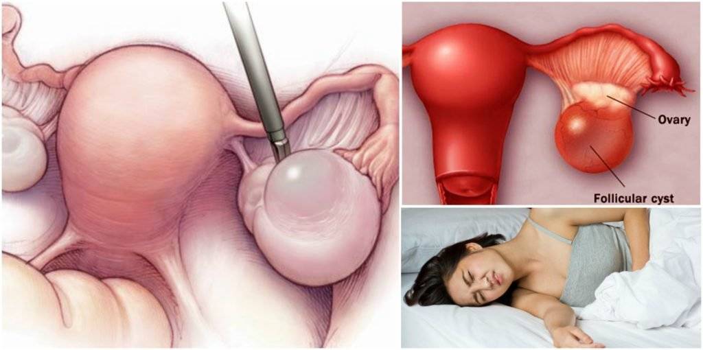 Апоплексия яичника: симптомы и лечение