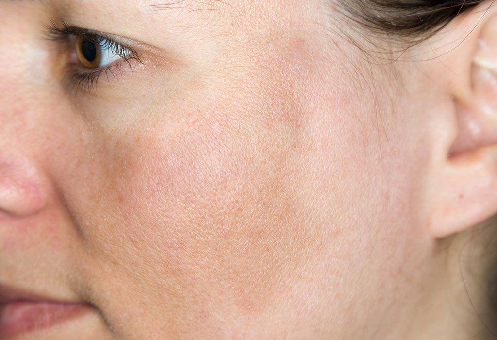 Пигментные пятна — причины появления на лице и теле, фото, лечение дома