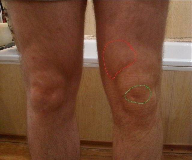 Супрапателлярный бурсит коленного сустава – симптомы и методы лечения