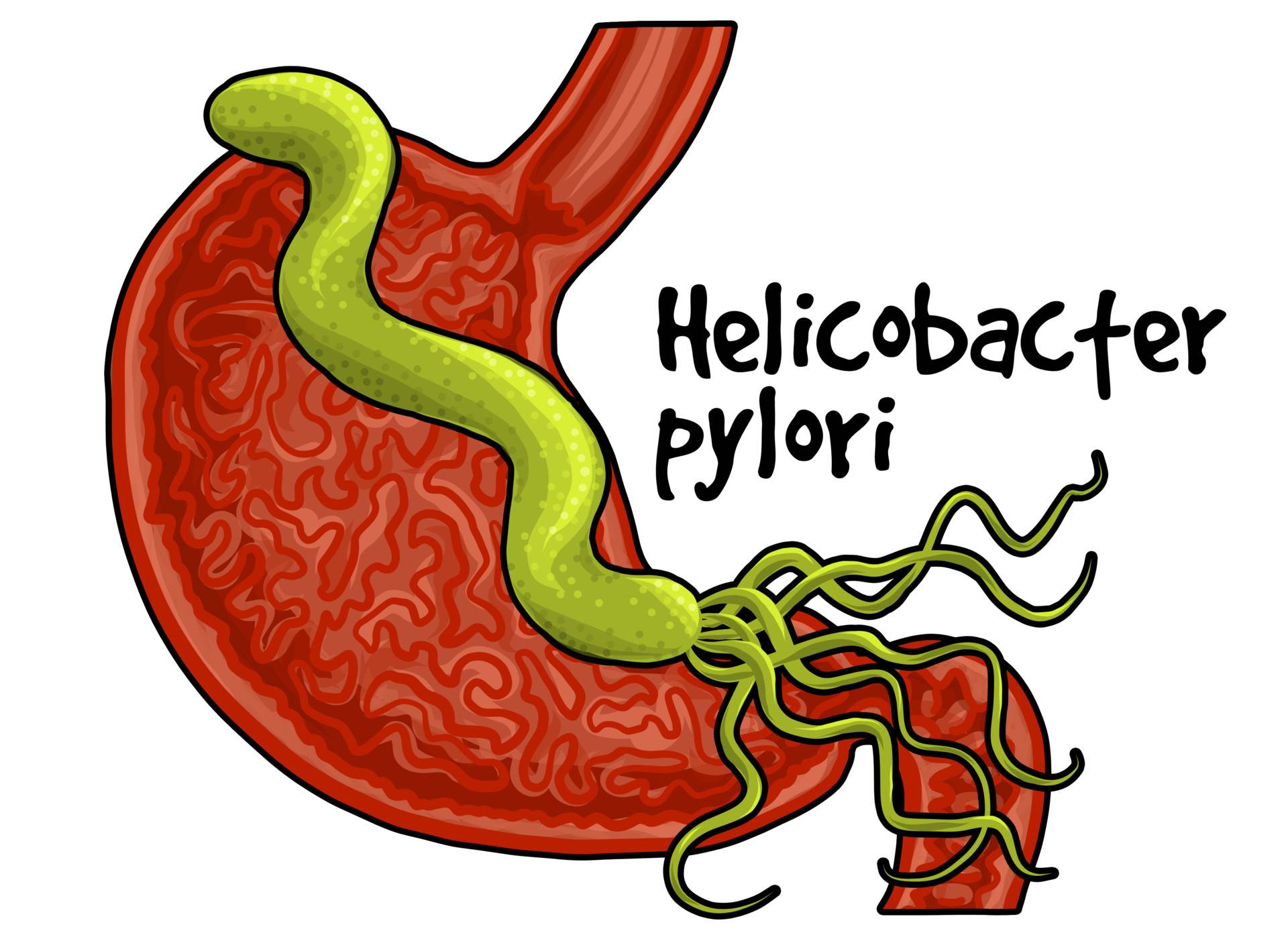 Бактерия хеликобактер пилори в желудке: как лечить, причины, симптомы