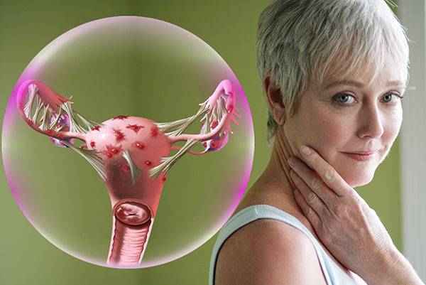 Как лечить эндометриоз матки при климаксе? | климакс 24