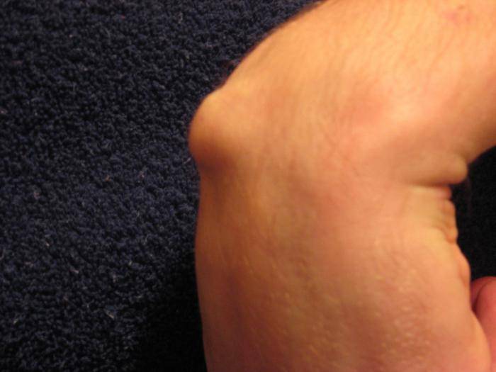 Шишка на кисти (запястье) руки: почему появляется и как лечить различными методами