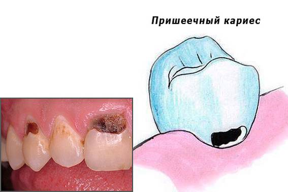 Кариес коря зуба: как лечить под десной, нужно ли удалять