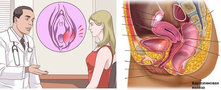 Воспаление бартолиновой железы — причины и лечение. как лечить бартолинову железу?