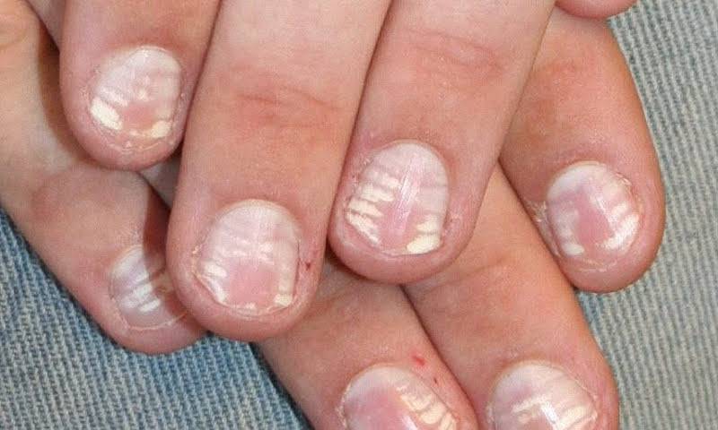 Белые пятна на ногтях пальцев рук: причина у взрослого и ребенка, что это значит. лечение лейконихии - белых пятнышек на ногтях