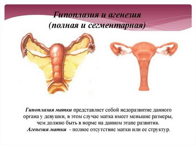 Как гипоплазия матки 1, 2, 3, 4 степени влияет на беременность