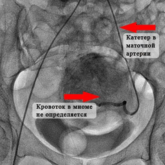 Эмболизация маточных артерий при миоме матки: лечение и последствия